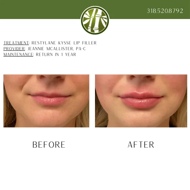 If fuller lips in on your 2026 wish list, text us "2026 lips" to 318.523.2722 to get scheduled for a free consultation and see how you can get the lips of your dreams with low monthly payments with no interest or credit checks!

 #beforeandafter #lipfiller #restylanekysse #getthelips