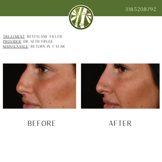 A liquid rhinoplasty, or non-surgical nose job, is a cosmetic procedure that uses dermal fillers injected into the nose to temporarily reshape and improve its contour, symmetry, and appearance without surgery. It's ideal for minor adjustments, like smoothing humps, lifting a droopy tip, or correcting asymmetry, offering immediate results with minimal downtime, unlike traditional surgery. To schedule a free consultation for a liquid rhinoplasty with Dr. Seth Fruge, text "liquid rhino" to 318.523.2722!