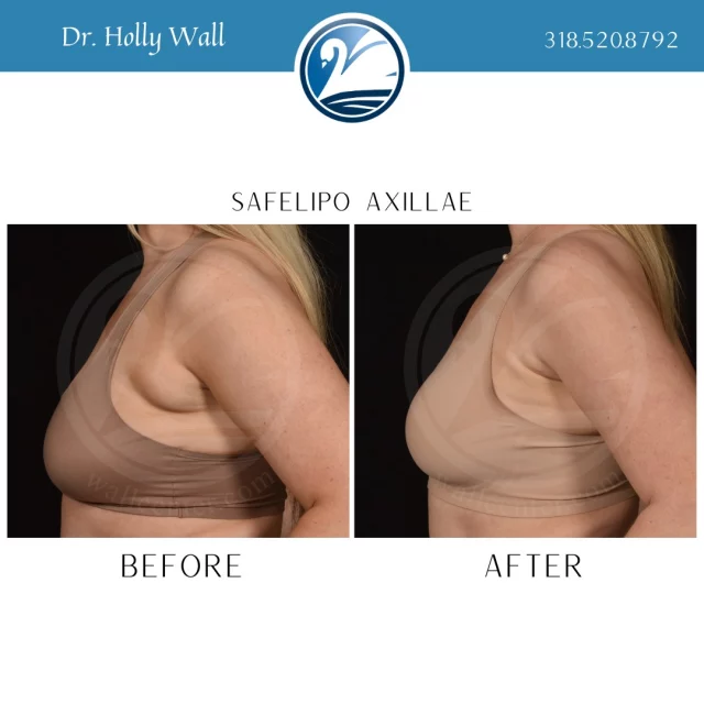 Armpit (axillary) liposuction is a minimally invasive, typically under-two-hour procedure that removes stubborn, localized fat deposits (sometimes called "bra fat") in the underarm area to create a smoother, more contoured upper body. It is popular for reducing skin folds and improving comfort, reduces sweating, and is often combined with breast surgery. When considering a breast augmentation, ask if SAFELipo to armpit fat would be a good add on option for you. To schedule a consultation with Dr. Holly Wall text "HCW consult" to 318.523.2722.