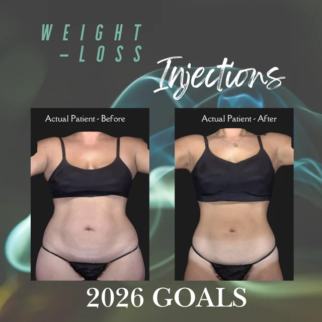 Our slim shots can help you reach your weight-loss goals for 2026 while also protecting you against heart and kidney disease! For more information about our slim shots, TEXT "slim shot info" to 318.523.2722.
#skinnyshot #slimshot #weightlossinjections #glp1forweightloss #semaglutide #semaglutideweightloss #tirzepatideweightloss #weightlossgoals #weightlossinspiration #weightlosssuccess