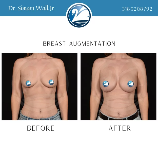 Now is the time to schedule your breast augmentation consultation so that you can be bikini ready this summer! TEXT "consult with SWJ" to 318.523.2722 to get started on the steps to get in that itty bitty bikini you've been wanting.