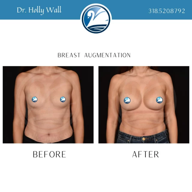 Caught you staring 👀. That's okay, we can't stop staring either 😍😍. 

For a consultation with Dr. Holly Wall, TEXT "Dr. Holly consult" to 318.523.2722.

 #beforeandafter #plasticsurgeryresults #plasticsurgerybeforeandafter #breastaugmentations #boardcertifiedplasticsurgeon #plasticsurgery