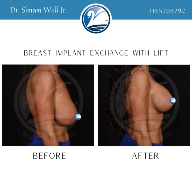 You will always get honest treatment recommendations at The Wall Center. If you need a lift, we will not try to convince you otherwise. If you put your trust in us, we will make sure you get the quality of surgery and care you deserve! For a consultation call 318-520-8792.