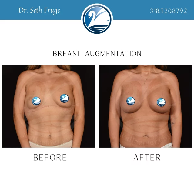 Ger your beach-bod ready for the boat! Spring is quickly approaching and now is the perfect time to schedule your breast augmentation consultation to be bikini ready this summer. Text "Aug with Dr. Fruge" to 318.523.2722 for more information. 

 #beforeandafter #plasticsurgeryresults #plasticsurgerybeforeandafter #breastaugmentations #plasticsurgery