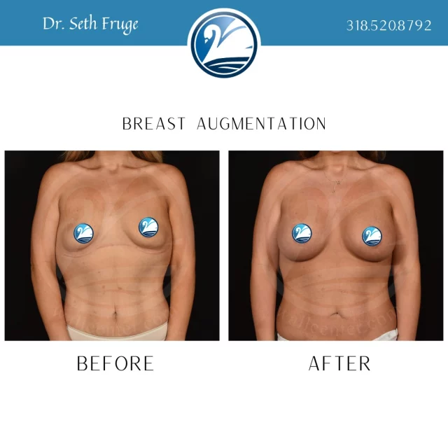 Get bikini ready now! Spring is just around the corner, and now is the time to get your breast augmentation consultation scheduled to be beach/boat/bikini ready this summer. If you are interested in a consultation with Dr. Seth Fruge, TEXT "Consult with SF" to 318.523.2722 for more information. 

 #beforeandafter #plasticsurgeryresults #plasticsurgerybeforeandafter #breastaugmentations #breastaugmentation #breastimplants #shreveportplasticsurgeon