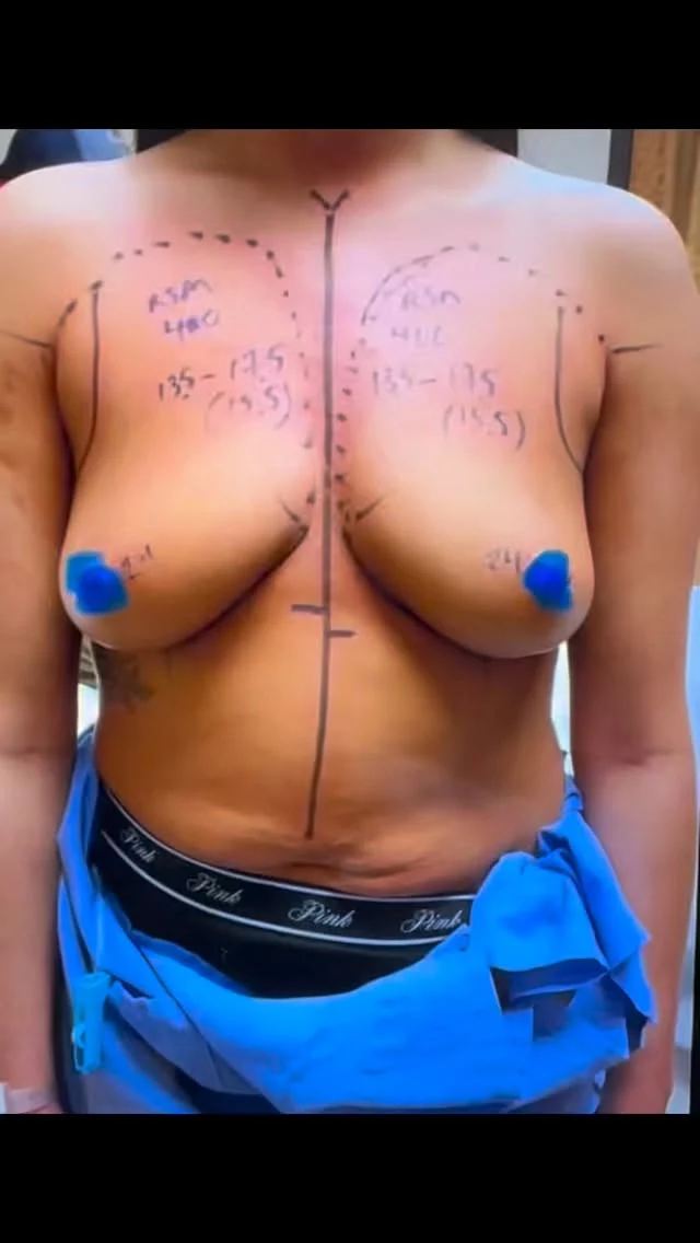 See this patient’s breast augmentation result! Dr. Simeon Wall Jr. was able to avoid a lift and delivered amazing results. #Breastaugmentation