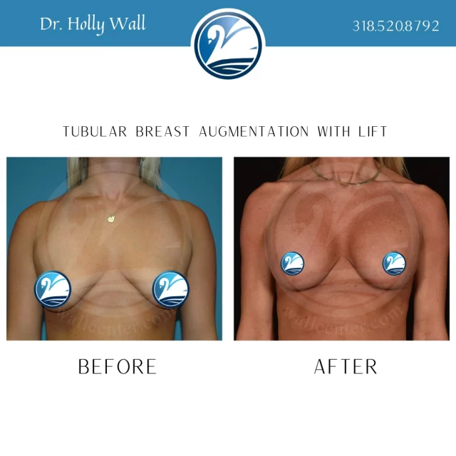 What are "tubular breasts" and how to correct them? Tubular breasts are a congenital anomaly where breasts fail to expand fully during puberty, resulting in a narrow, constricted, tube-like, or drooping shape. Common features include large, puffy areolas, a high breast crease, and significant asymmetry. Treatment involves surgical correction, often using implants with a breast lift. This patient's after photos were taken 17 YEARS post-op and she still looks amazing!! 

For a consultation with Dr. Holly Wall, text "HCW consult" to 318.523.2722.

#tubularbreasts #breastaugmentation #breastlift #breastliftwithimplants #mastopexy #mastopexywithimplants #mastopexyaugmentation