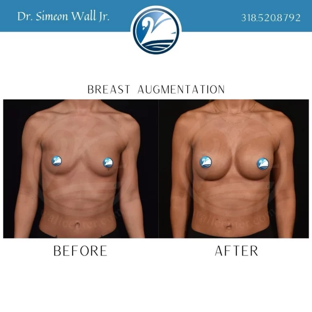 Today is “Tax Day” and we have a little (or big) idea on a great investment on your return.

Let’s girl-math this! A breast augmentation is probably less expensive than you think. 
Starting at only $5500 - and implants lasting on average about 10 years, that’s about $550 a year. 
Now lets math that further... $550 a year is about $46 a month which is equivalent to the price of a gym membership. 
Now that comes to about $11.50 a week which is less than the cost for 1 movie ticket. 
Breaking that down further, is $1.64 a day. You can’t even buy a cup of coffee at a gas station for less than $2! 

One might dare say that a breast augmentation is a financial investment in the future of your happiness. Ready to schedule your consultation? Call 318.520.8792 or Text 318.523.2722.