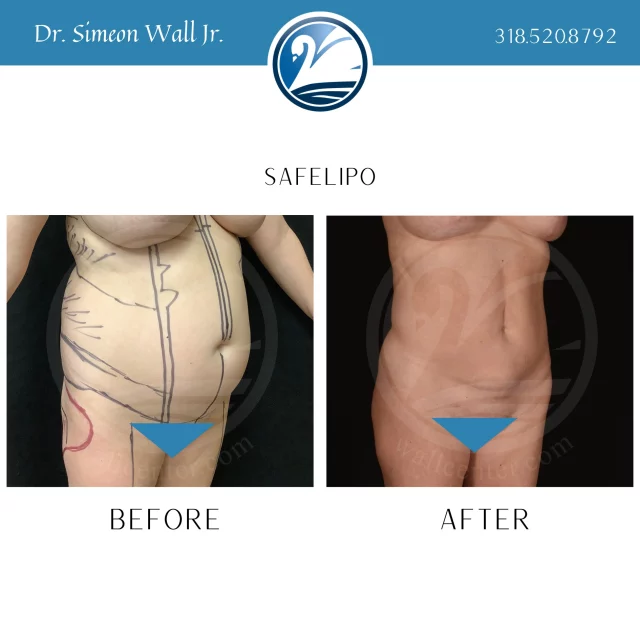 Not everyone is a great candidate for just SAFELipo, but if your skin is taunt and your abdominal muscles aren't stretched out too bad, you could be lucky enough to get Dr. Wall Jr.'s patented SAFELipo procedure and avoid a tummy tuck procedure. Trust us when we say, that if you want results like this, you use a board certified plastic surgeon like Dr. Simeon Wall Jr. These are not the results you should expect to get by choosing a plastic surgeon through price shopping. To schedule a consultation call 318.520.8792 or text 318.523.2722.